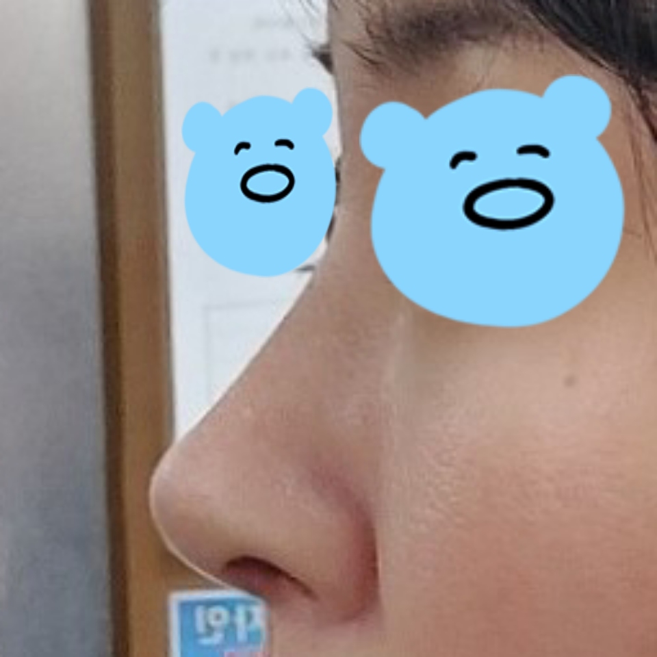 코수술 고민하시는 분들은 유영문 원장님을 만나보세요 ~