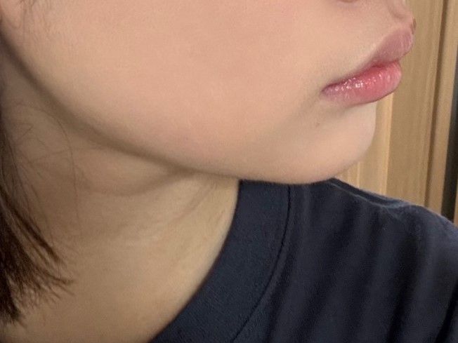 이중턱,볼살이 확실히 갸름해져서 너무 만족해요