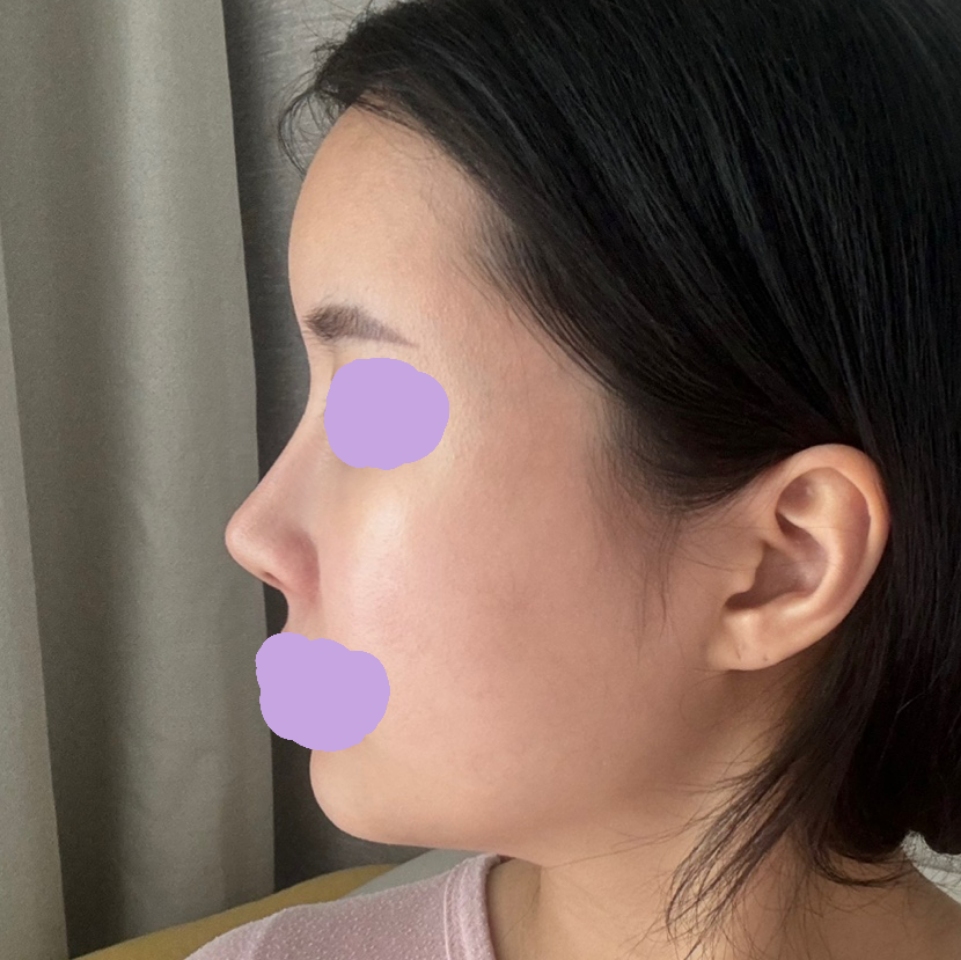 유영문 원장님께 수술 받은지 6개월차 입니다 !