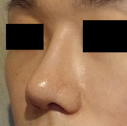 남자코수술 비포애프터입니다!