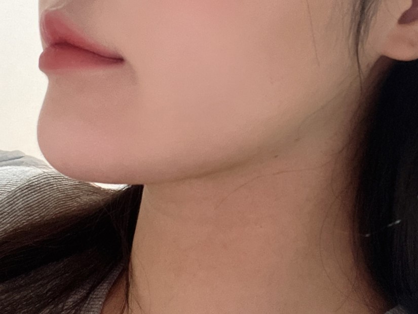 수술 결과 넘 만족스럽습니다 ㅜㅜ이중턱아 이제 안녕 !!