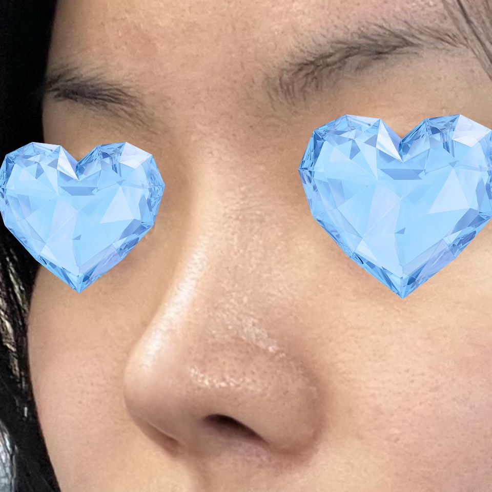 코 수술 6개월차 잘 유지중이에요 !