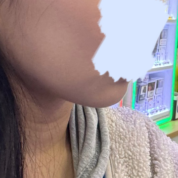 이중턱지흡+실리프팅+사각턱보톡스 1개월