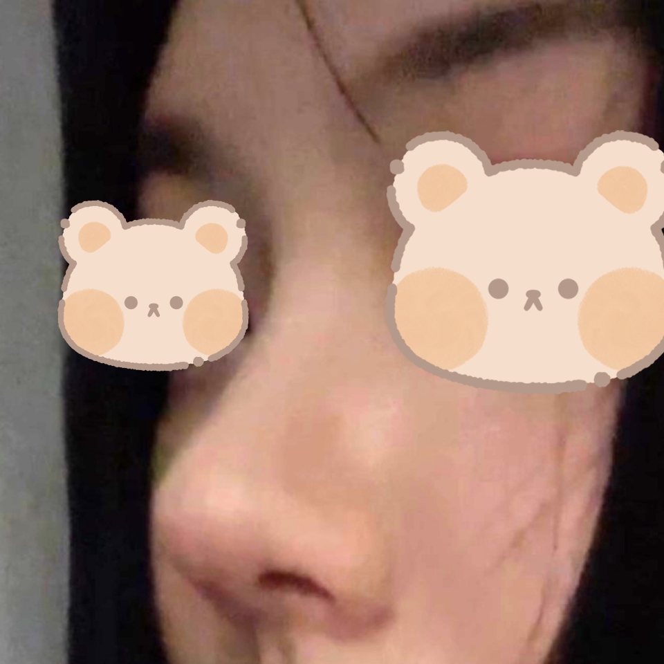 코수술 후 정말 많이 예뻐졌어용 ㅎㅎ