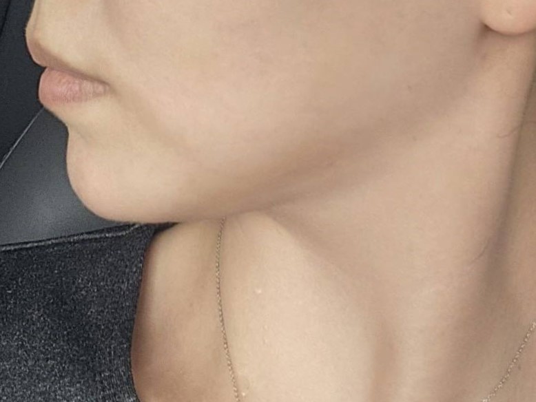 얼굴지방흡입 바이브 추천합니다ㅎㅎ