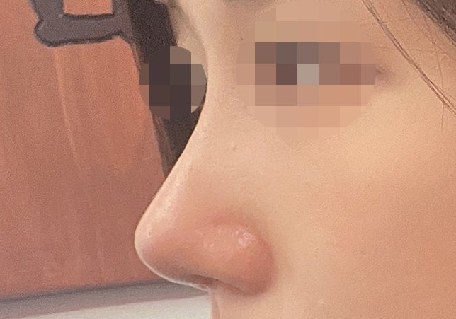 기능코 무보형물 수술 3개월차~~