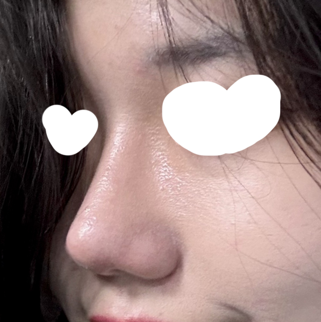 수술후__1__-_코.jpg