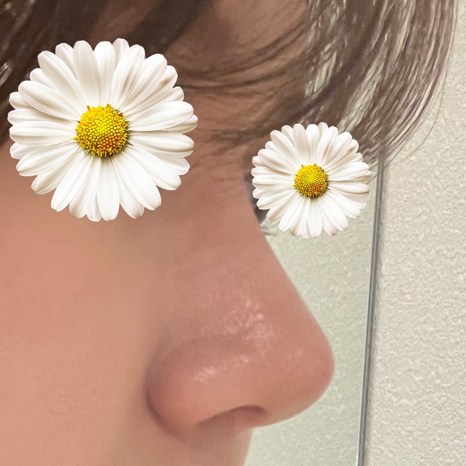 코수술 너무 만족스러워용 ㅎㅎ