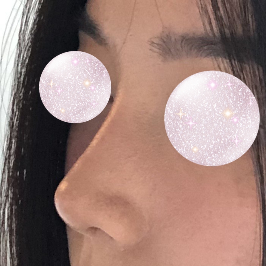 코수술 후 이제 코 뽀샵 안해요 !!