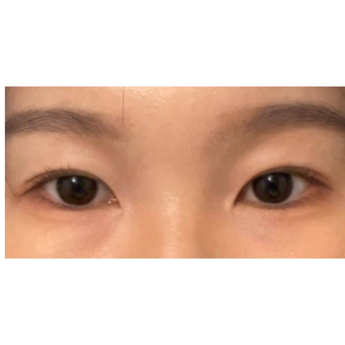 티 안나고 자연스럽게 예뻐져서 너무 만족해요 ㅎㅎ