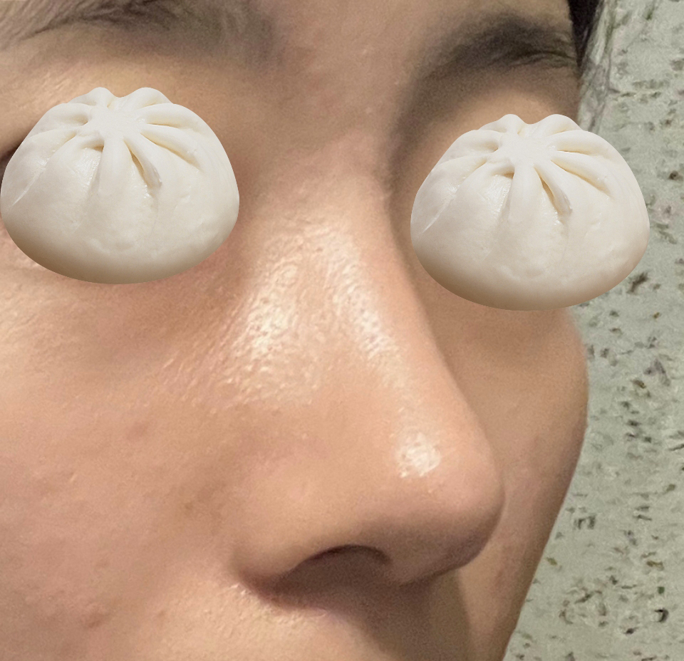 무보형물코성형 잘됐습니닷