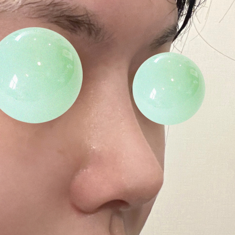 바이브에서 코수술 후 여기저기 추천하고 다닙니당