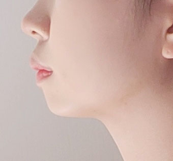 평소 스트레스였던 턱살 드뎌 이별했네요ㅎㅎ