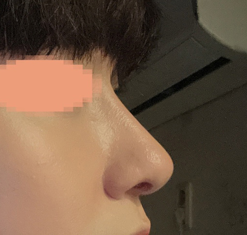 남자코수술 2개월차됐습니다^^