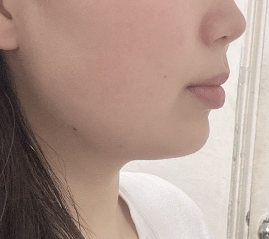 얼굴지방흡입 후기적어요^^*