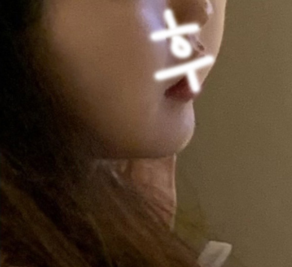 이중턱지방흡입 1달차 전후사진 올려보아용