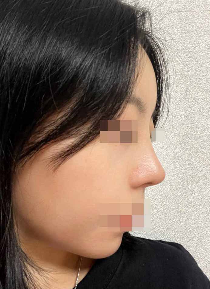 코, 이마턱지방이식 3주차에용