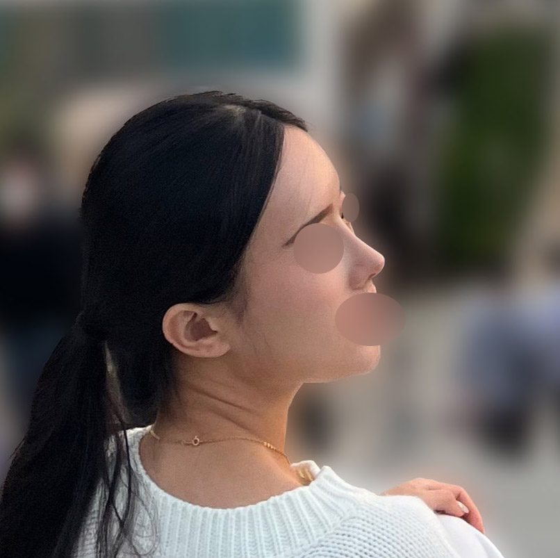 코랑 풀페지방이식 둘다 만족해요:)