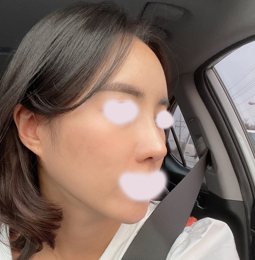 풀페지이+코 1달됐어요~