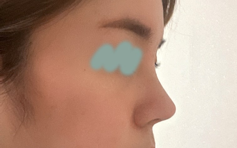 코 수술 3주차^^