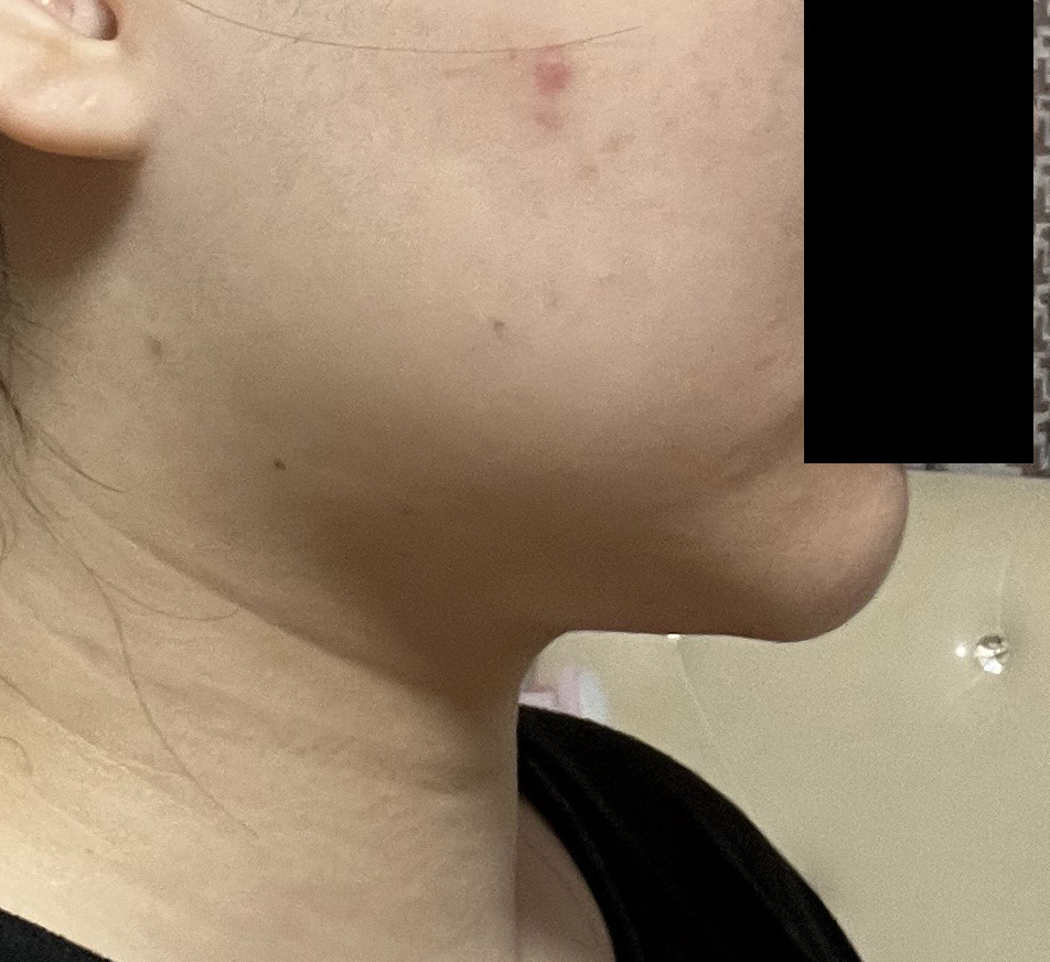 3개월전 바이브에서 얼굴지흡받은 후기적어요!