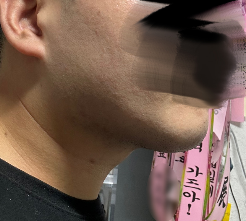 지방흡입 왜 이제 했나 싶어요 ㅎㅎ 매우 만족합니다