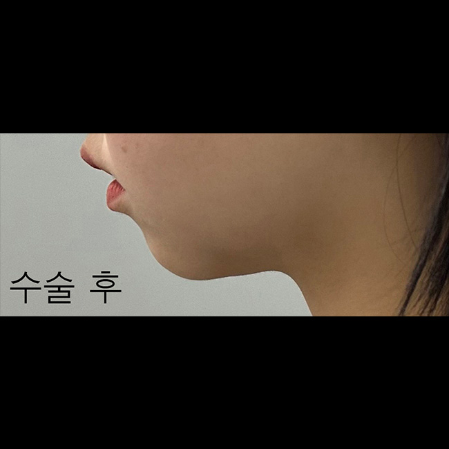 얼굴지방흡입 하길 잘했어요 ㅎㅎ-수술2개월차