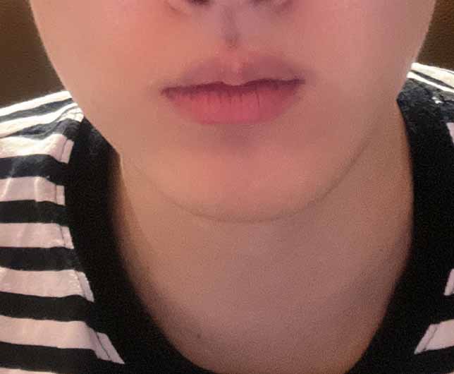 얼굴지방흡입 너무 잘됐어요