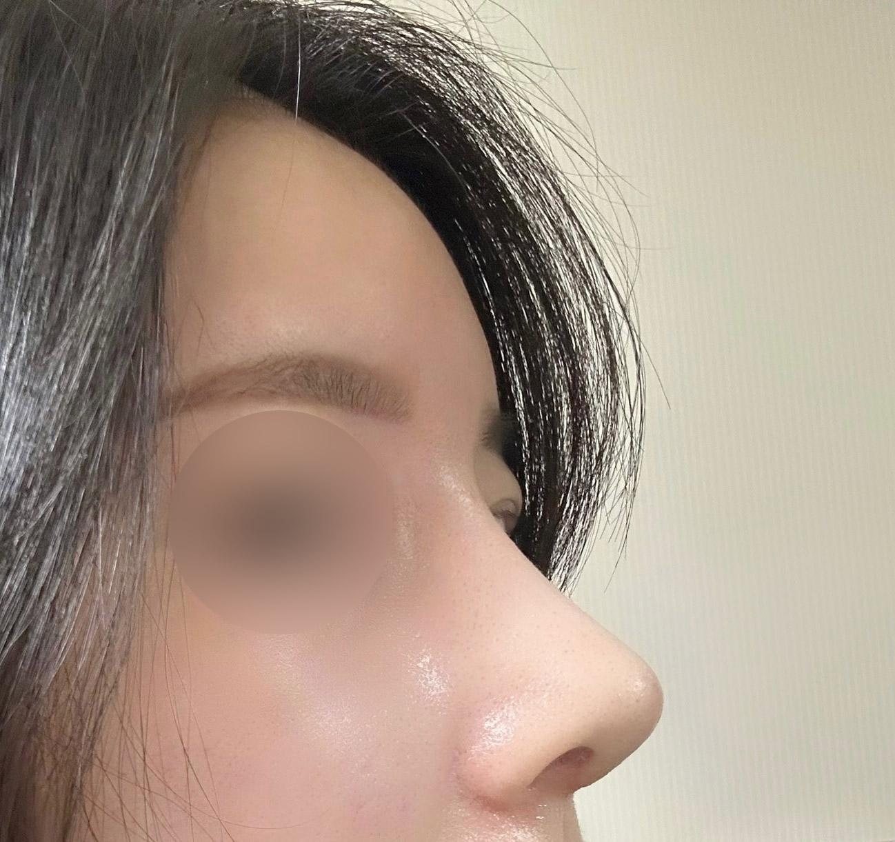 매부리코성형 리얼후기~~