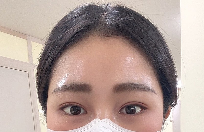 쌍꺼풀재수술 + 이마거상 6개월째ㅎㅎ