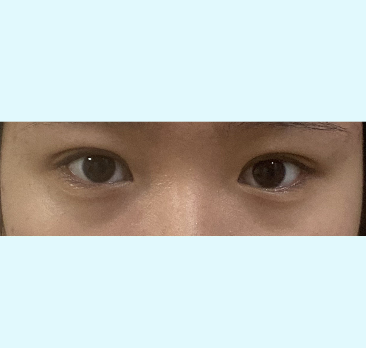 매몰법으로 자연스럽게 쌍수한 후기 ㅎㅎ