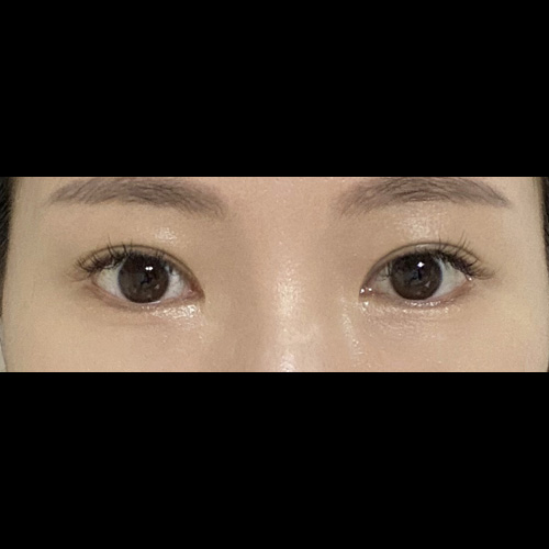 세번째 눈수술 성공입니다.