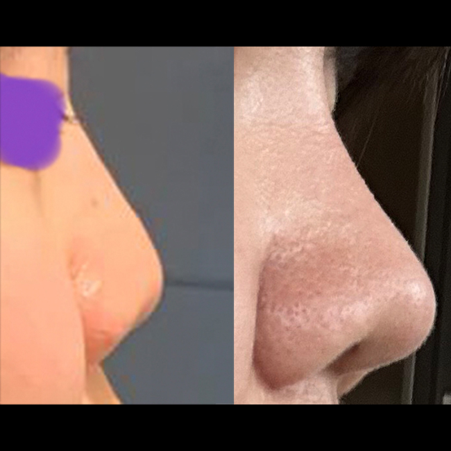 복코성형했어용 ㅎㅎ