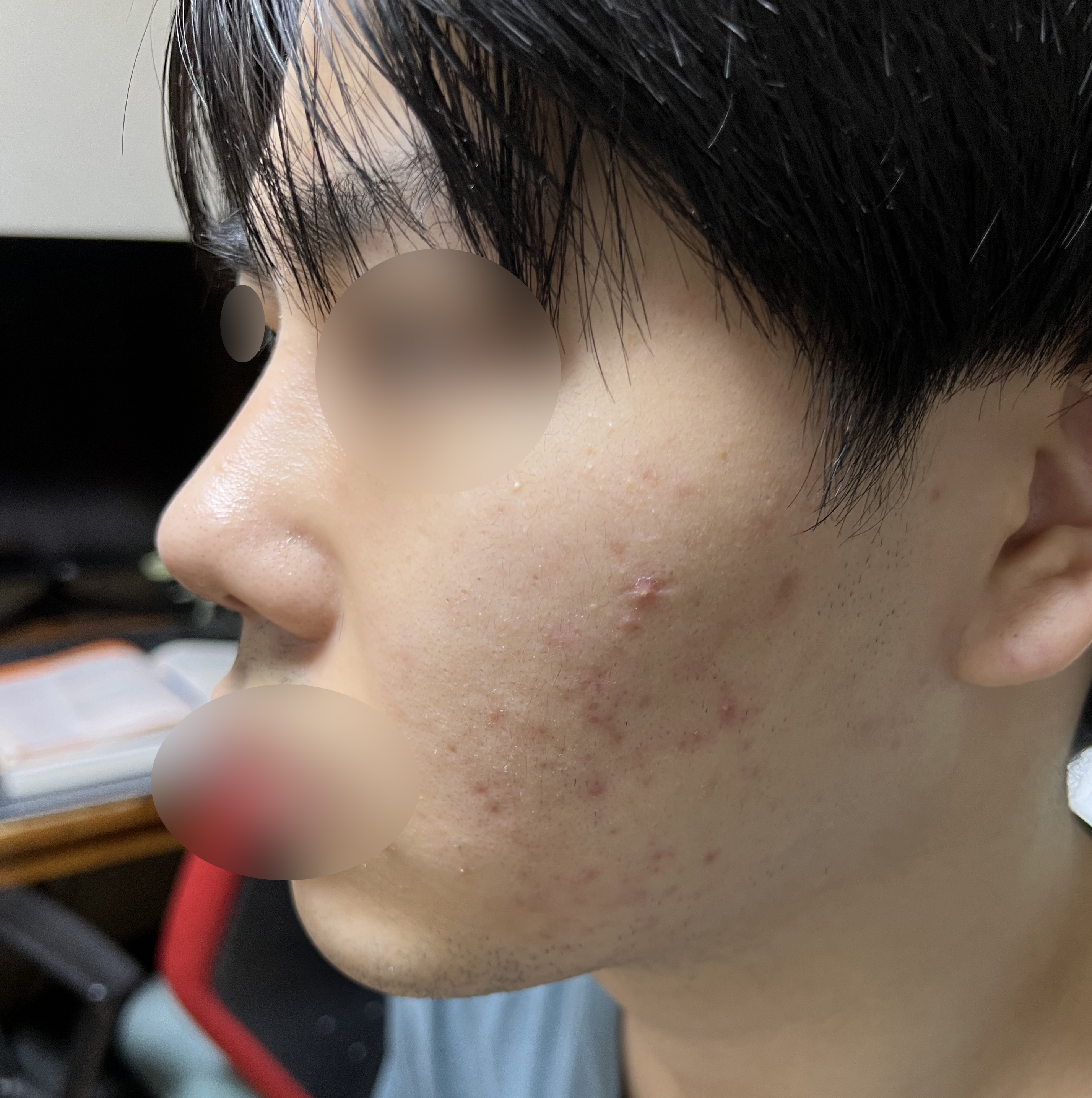 기능코성형+눈성형+무턱보형물 후기