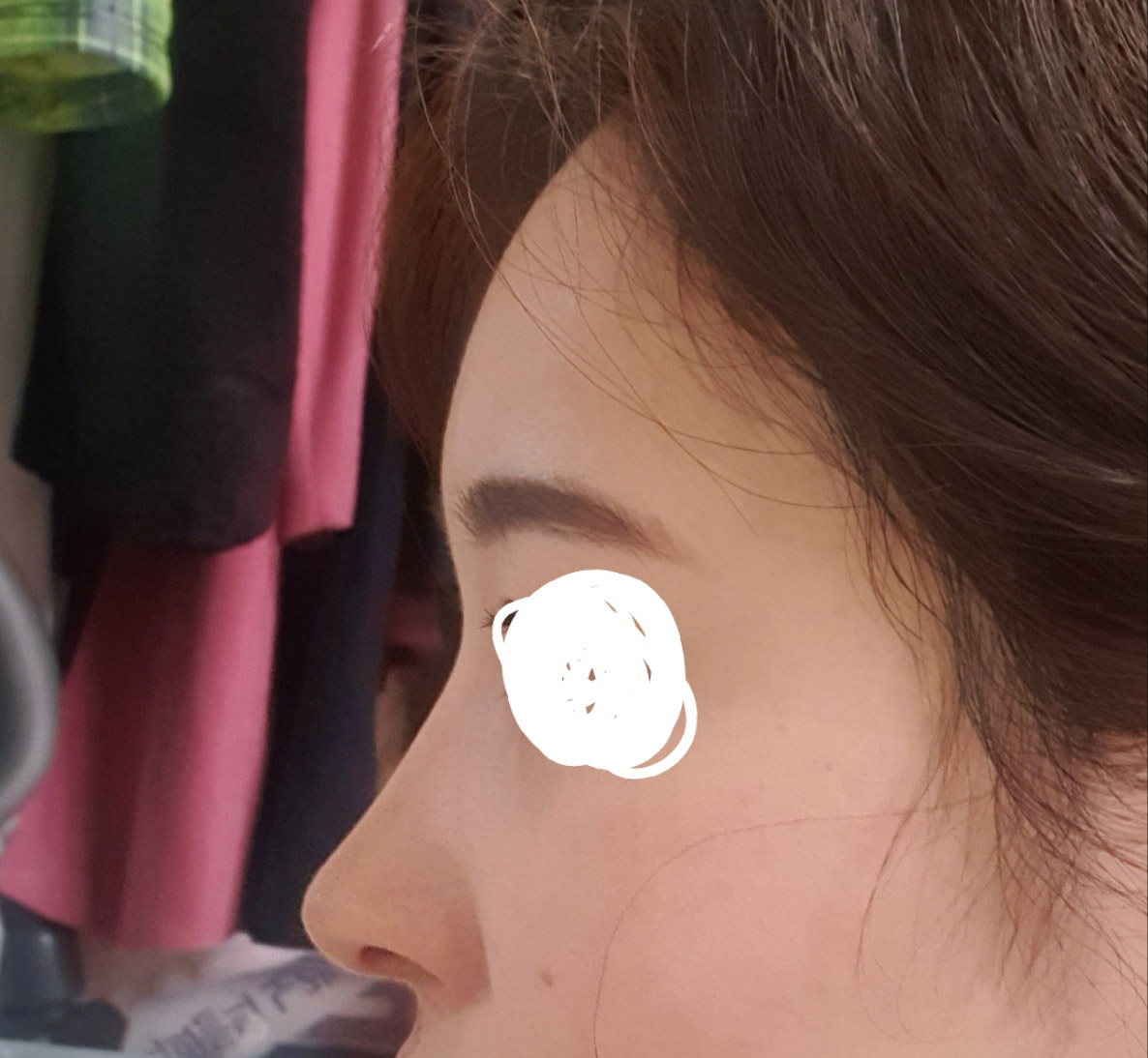 원하던 라인이에요ㅎㅎ(코, 지방이식)