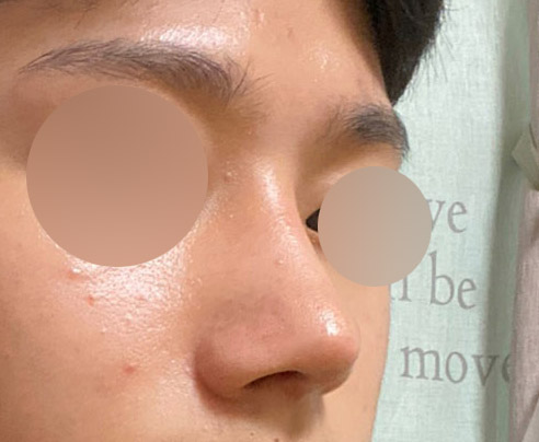 남자 매부리코성형 바이브에서 하세요!