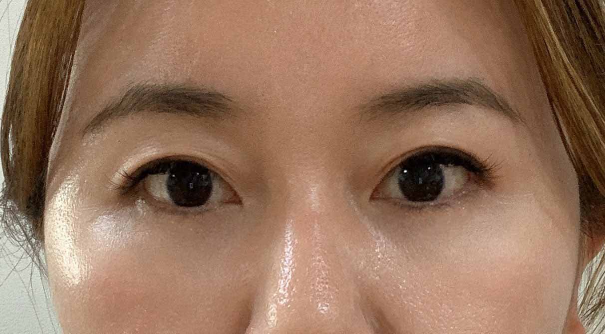 눈밑지방재배치랑 얼굴지방이식 후기에요~!!