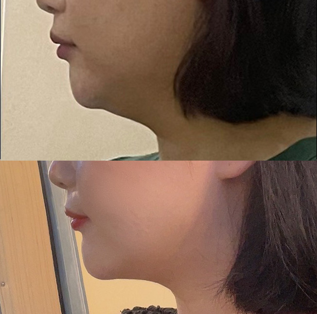 수술 후 턱과 목이 구별되게 보여요 ㅎㅎ
