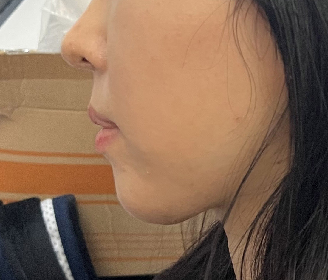 지방흡입하고 턱갸름갸름