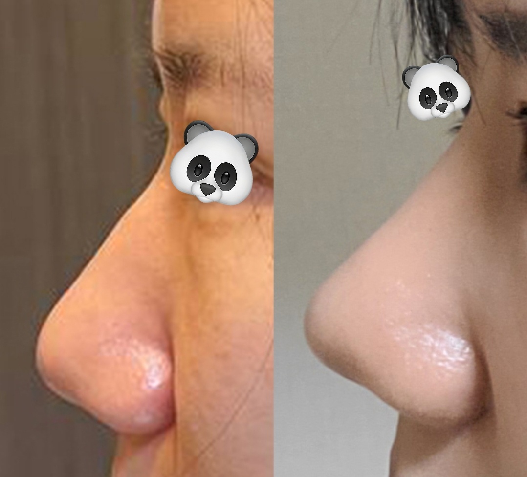 기능코성형 만족후기!