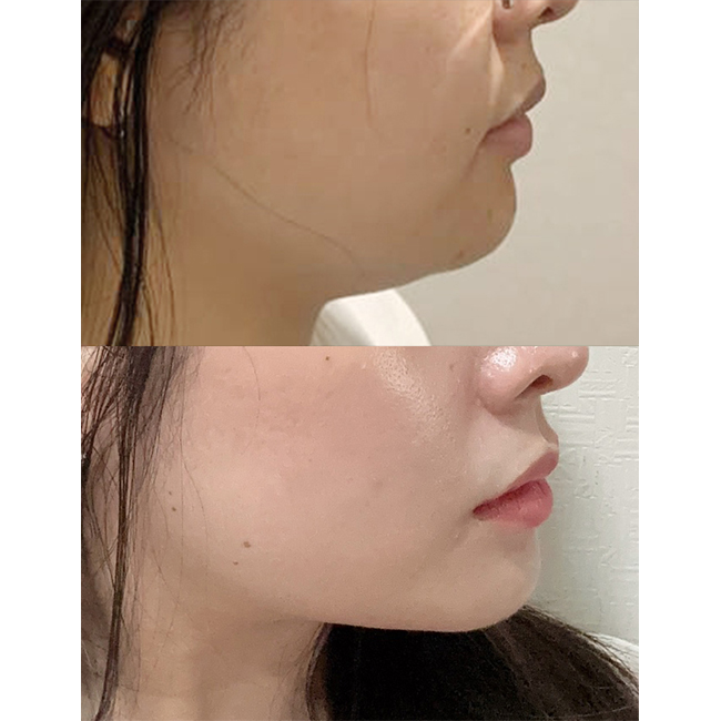 지방흡입2개월차인데 효과 너무좋음요!