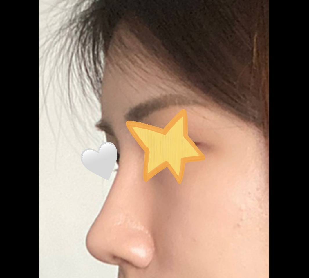 코성형+얼굴지방이식 5개월차 만족도100%