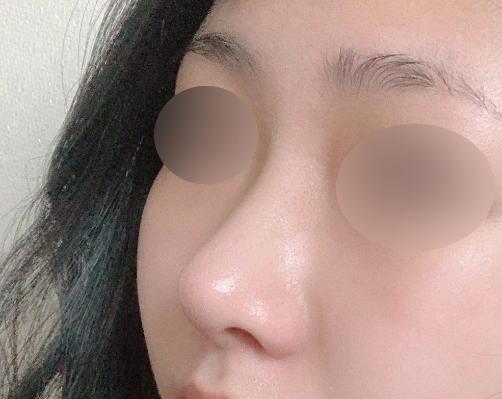 무보형물코성형 6개월차!!