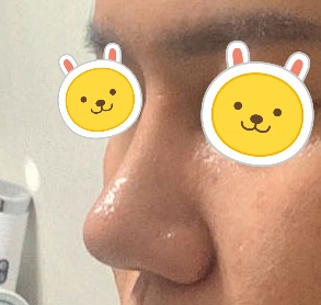 4개월차되니 붓기도 많이 빠지고 모양 만족!!