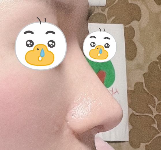 코성형4개월차입니당 자리 잘 잡고있어요 ㅎㅎ