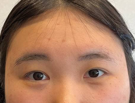수술전_1_-눈,_이마.jpg