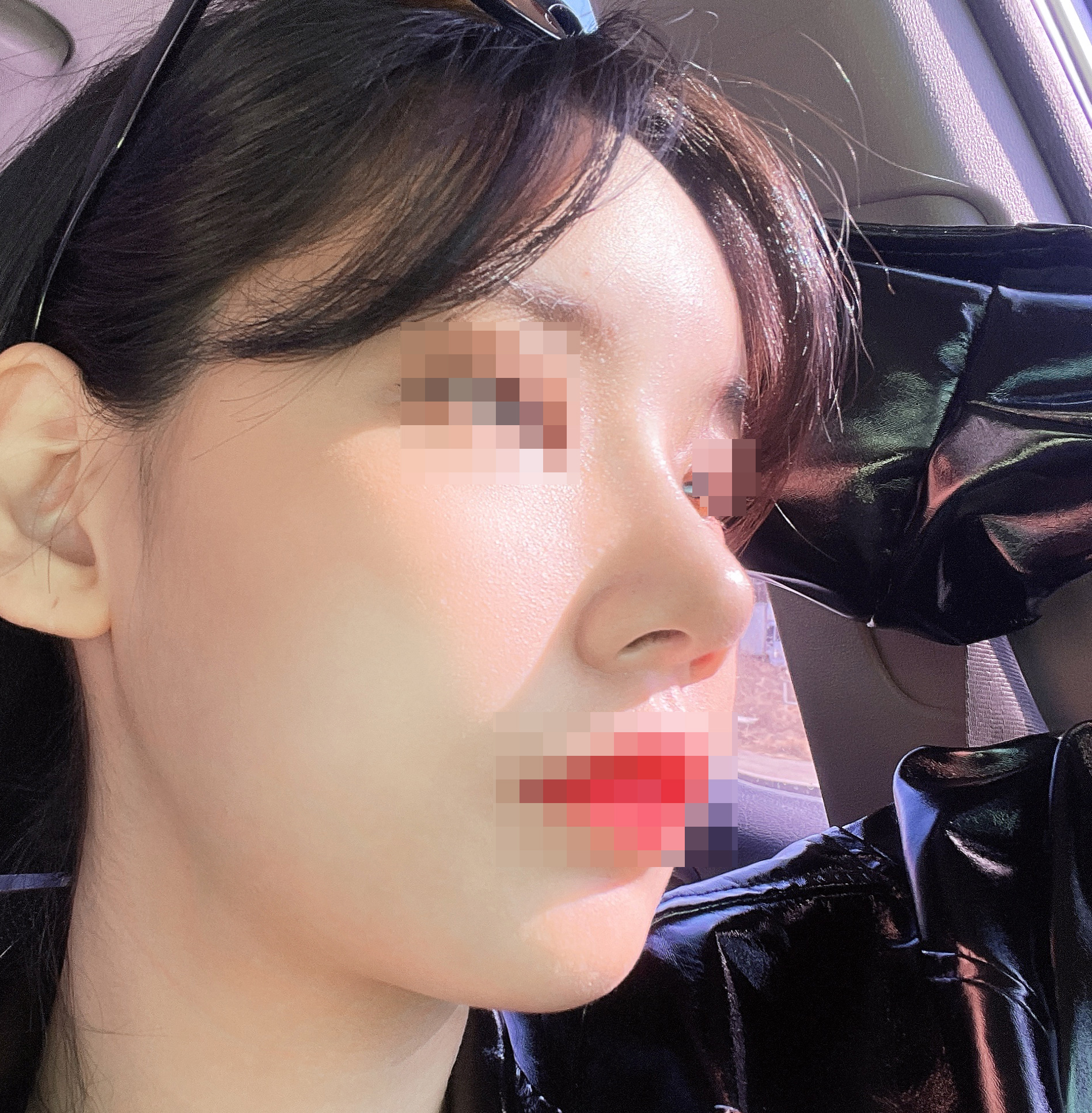 코+풀페이스지방이식+얼지흡 후기입니당(4개월차)