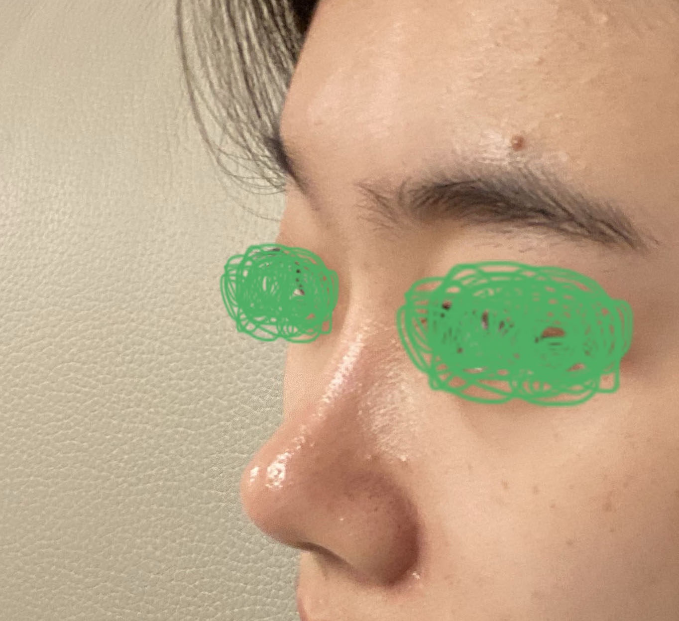 코수술4개월차! 자연스러워용