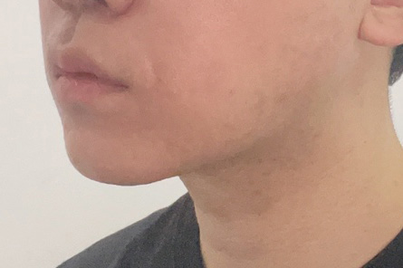 평소에 이중턱 고민이신분들에게 추천!