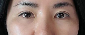 매몰+이중턱흡입+실리프팅 만족중이에요